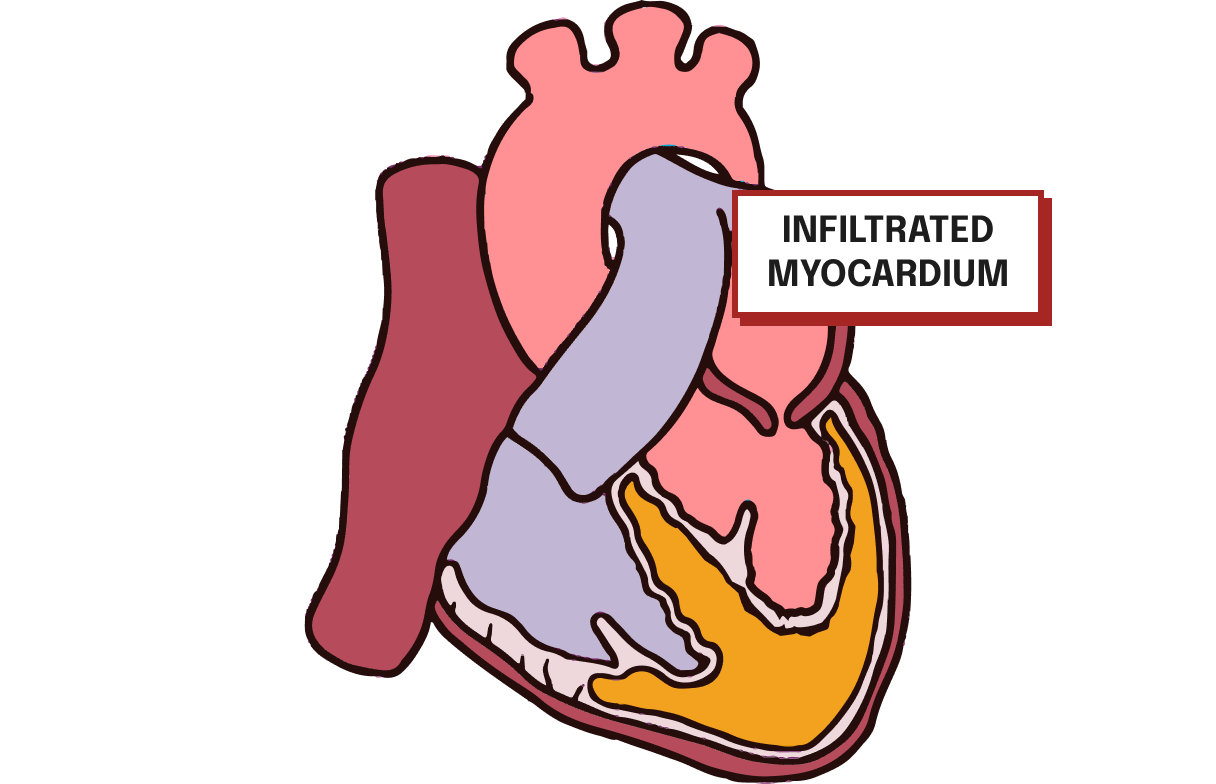 Infiltrated Myocardium